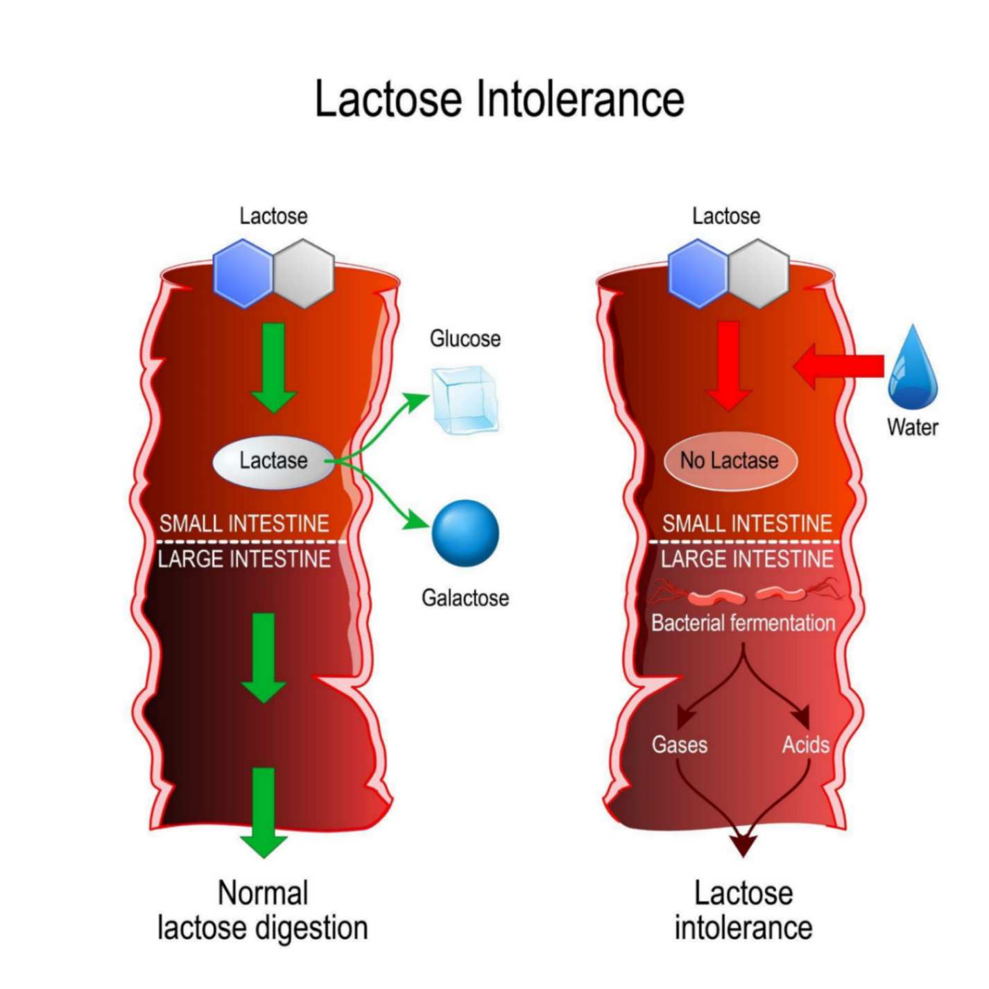 Lactose Intolerance