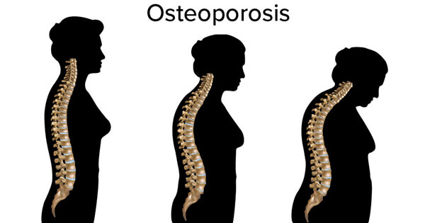 Osteoporosis